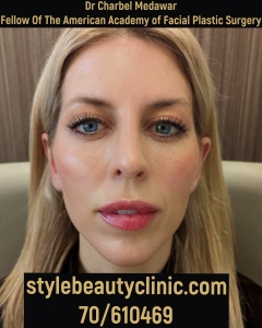 heidi bitton journey shreveport facial beautification makeover transformation glowup plastic surgery rhinoplasty blepharoplasty browlift botox fillers lip fillers chin jawline cheeks cosmetic aesthetic procedures