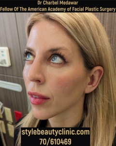heidi bitton journey shreveport facial beautification makeover transformation glowup plastic surgery rhinoplasty blepharoplasty browlift botox fillers lip fillers chin jawline cheeks cosmetic aesthetic procedures