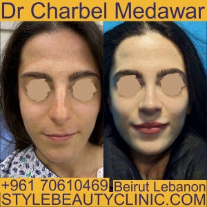 best nose surgeon in Lebanon
