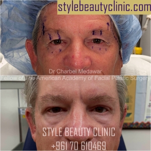 blepharoplasty browlift dr charbel medawar facial plastic surgeon style beauty clinic beirut lebanon