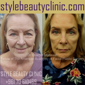 blepharoplasty browlift upper and lower fat pad removal drcharbel medawar facial plastic surgeon style beauty clinic beirut lebanon 55