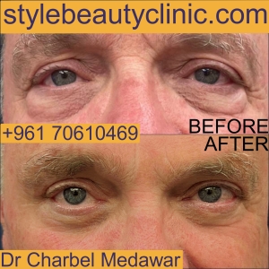 blepharoplasty dr charbel medawar style beauty clinic lebanon