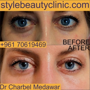 dr charbel medawar eyelid surgery lebanon