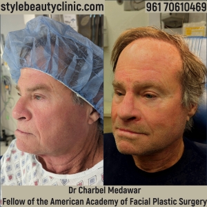 dr charbel medawar facelift Lebanon style beauty clinic