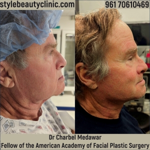 dr charbel medawar facelift beirut lebanon style beauty clinic