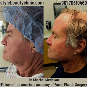 dr charbel medawar facelift style beauty clinic