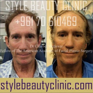 dr charbel medawar otoplasty ear surgery beirut lebanon style beauty clinic
