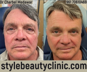 DR CHARBEL MEDAWAR BLEPHAROPLASTY LEBANON STYLE BEAUTY CLINIC COSMETIC surgery