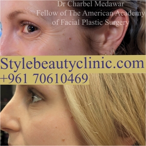 dr charbel medawar style beauty clinic botox lebanon