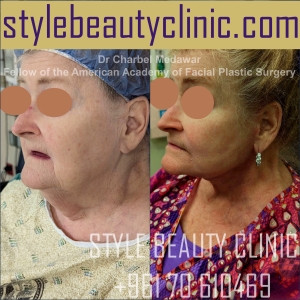 dr charbel medawar style beauty clinic facelift
