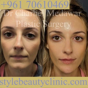 dr charbel medawar style beauty clinic filler lebanon