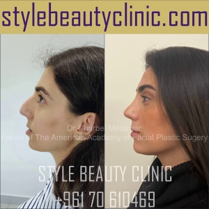 dr charbel medawar style beauty clinic rhinoplasty