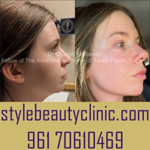jawline chin filler contouring plastic surgery beirut lebanon style dental clinic 22
