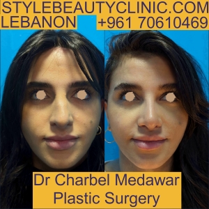 nose plastic surgery in lebanon