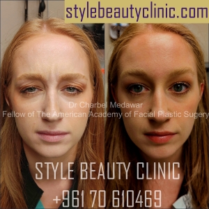 style beauty clinic dr charbel medawar browlift botox beirut lebanon plastic surgery