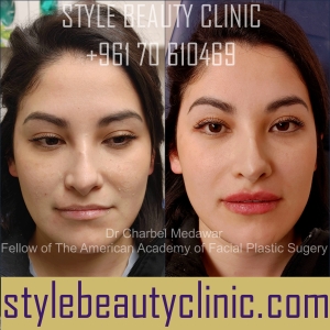style beauty clinic dr charbel medawar lip fillers beirut lebanon plastic surgery