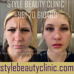 style beauty clinic dr charbel medawar lip fillers botox beirut lebanon plastic surgery