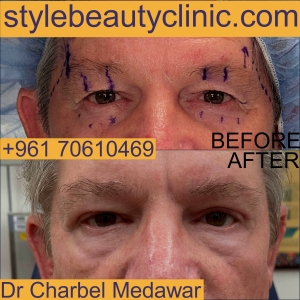 style beauty clinic dr charbel medawar oculoplastics