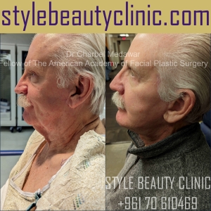 surgical facelift dr charbel medawar plastic surgery beirut lebanon style beauty clinic