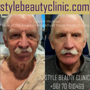 surgical facelift facial rejuvenation dr charbel medawar plastic surgery beirut lebanon style beauty clinic