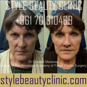 surgical facelift facial rejuvenation dr charbel medawar plastic surgery beirut lebanon style beauty clinic 100