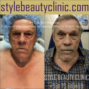 surgical facelift facial rejuvenation dr charbel medawar plastic surgery beirut lebanon style beauty clinic 44
