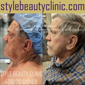 surgical facelift facial rejuvenation dr charbel medawar plastic surgery beirut lebanon style beauty clinic 55