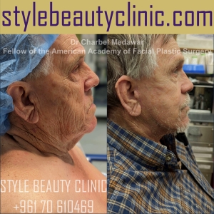 surgical facelift facial rejuvenation dr charbel medawar plastic surgery beirut lebanon style beauty clinic 66
