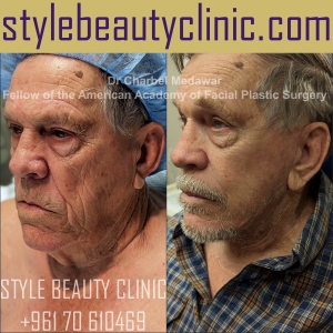 surgical facelift facial rejuvenation dr charbel medawar plastic surgery beirut lebanon style beauty clinic 77
