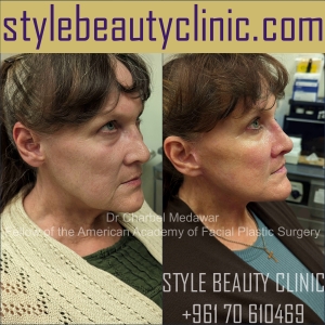 surgical facelift facial rejuvenation dr charbel medawar plastic surgery beirut lebanon style beauty clinic 88