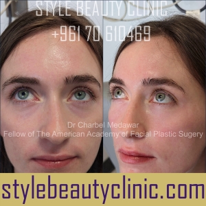 tear trough under eye fillers blepharoplasty browlift botox style beauty clinic dr charbel medawar beirut lebanon 3
