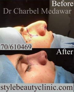 best nose plastic surgery lebanon dr charbel medawar