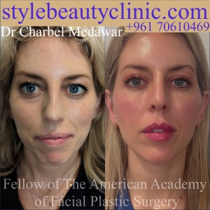 Dr Charbel Medawar Facial Beautification heidi Bitton Before After Plastic Surgery Face